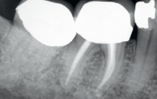 Clinical Case Study: Root canal re-treatment success with BioRoot Flow